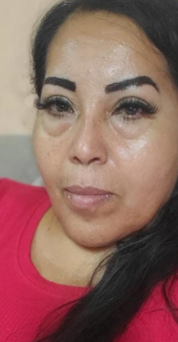Después - Tratamiento